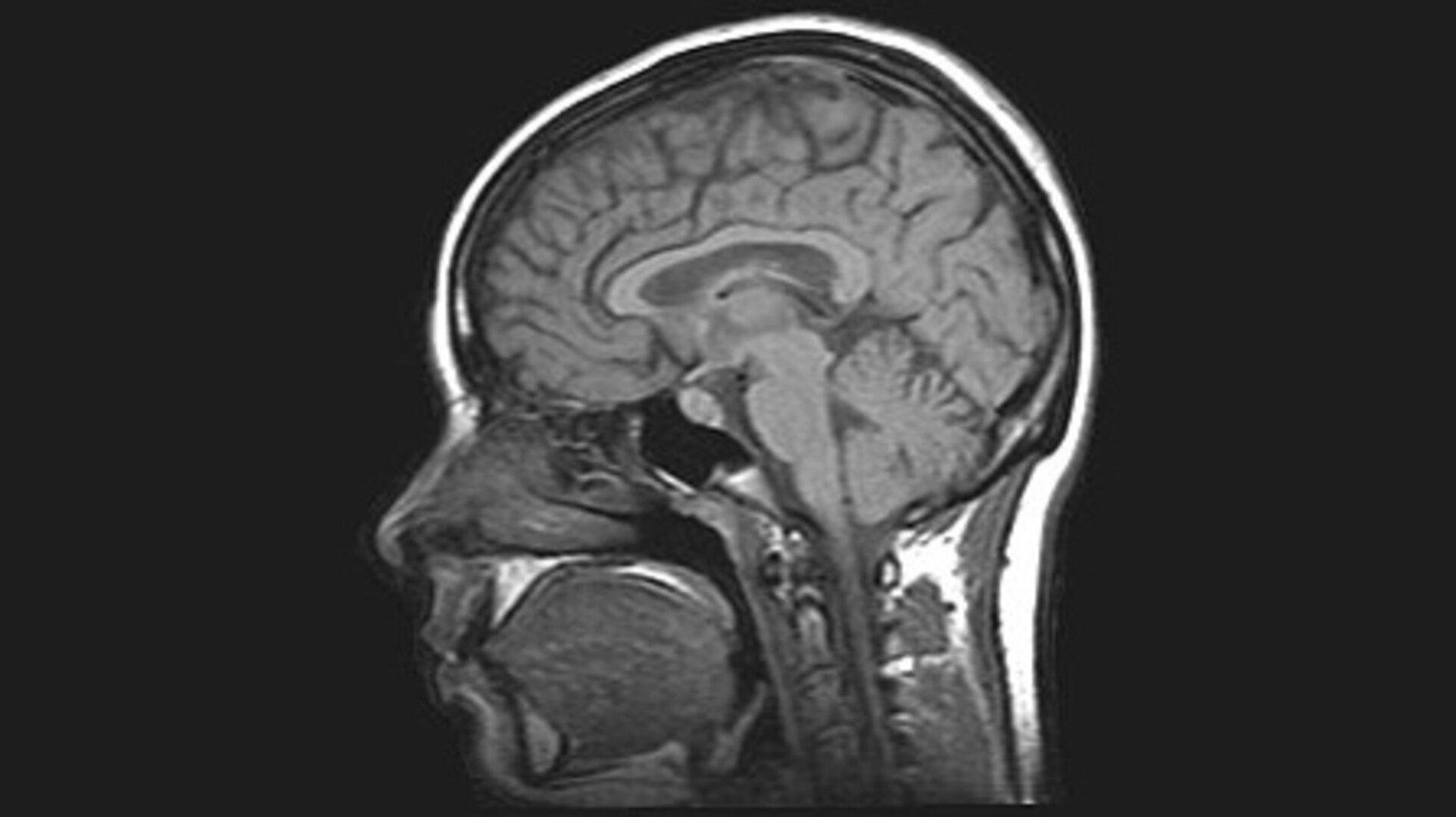Brain Tumor MRI Classification Project